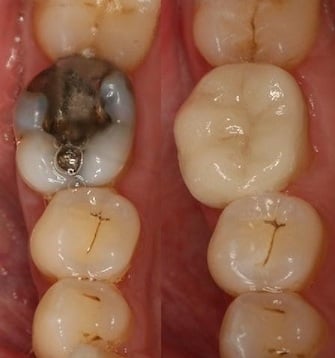 Cerec Dental Tooth Crowns Louisville Kentucky