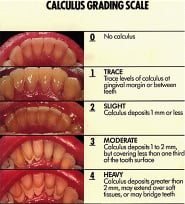 Dental Tooth Teeth Cleaning Hygiene Louisville Kentucky
