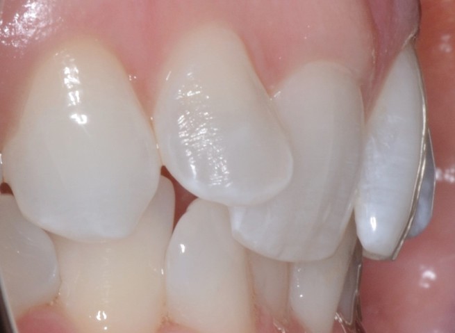 Dental Crowns Teeth Before Louisville Kentucky