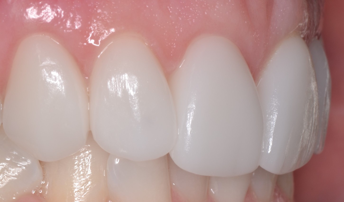 Dental Crowns Teeth After Louisville Kentucky