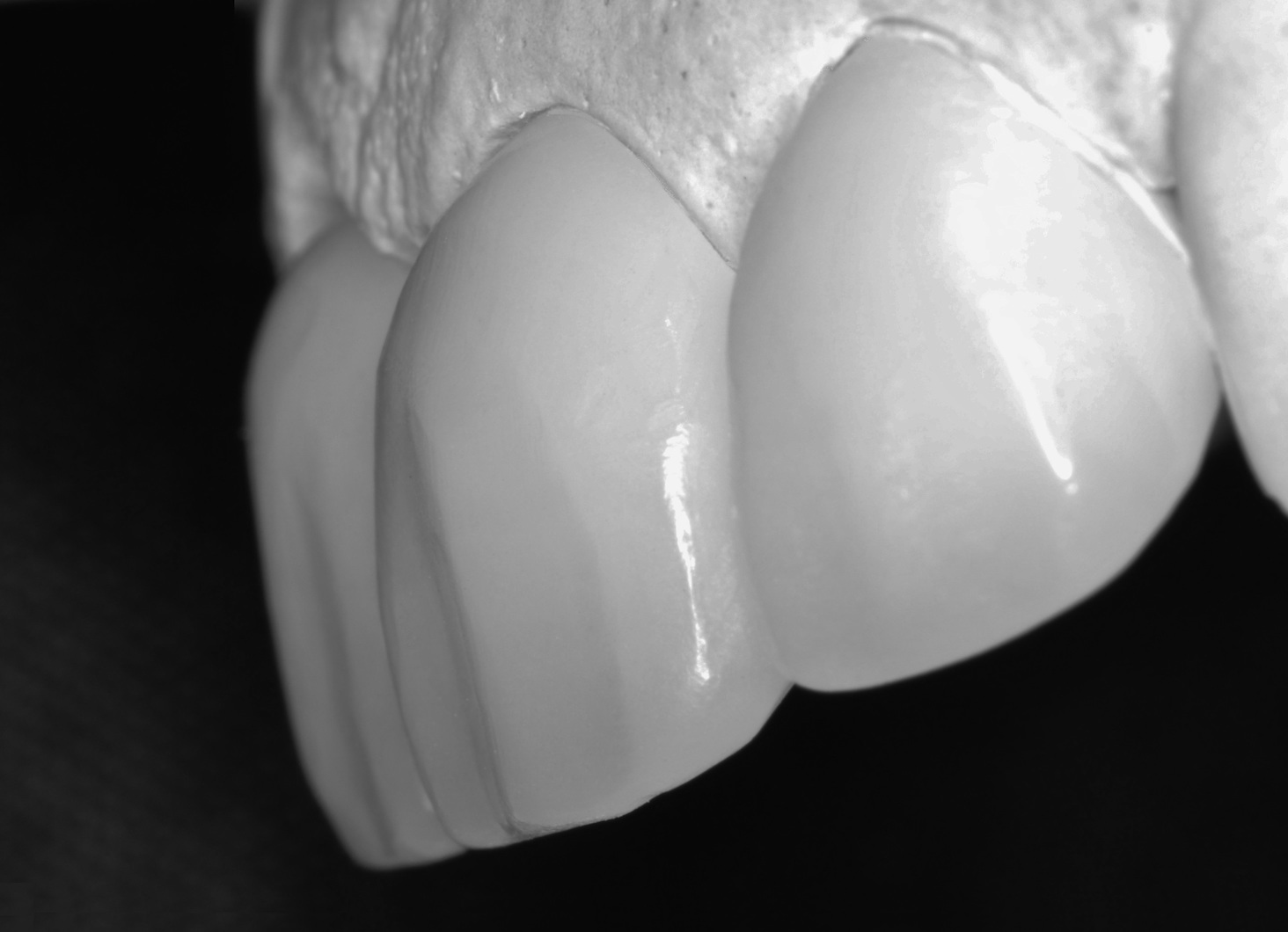 Dental Crowns After Louisville Kentucky