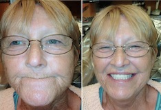 Dental Tooth Teeth Dentures Partials Louisville Kentucky