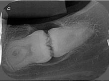 Dental Tooth Extractions Louisville Kentucky