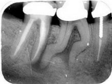 Dental Tooth Extractions Louisville Kentucky