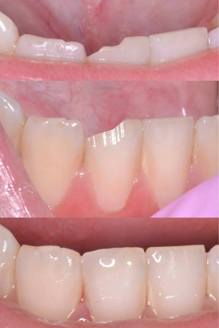 Dental Tooth-Colored Fillings Before Louisville Kentucky
