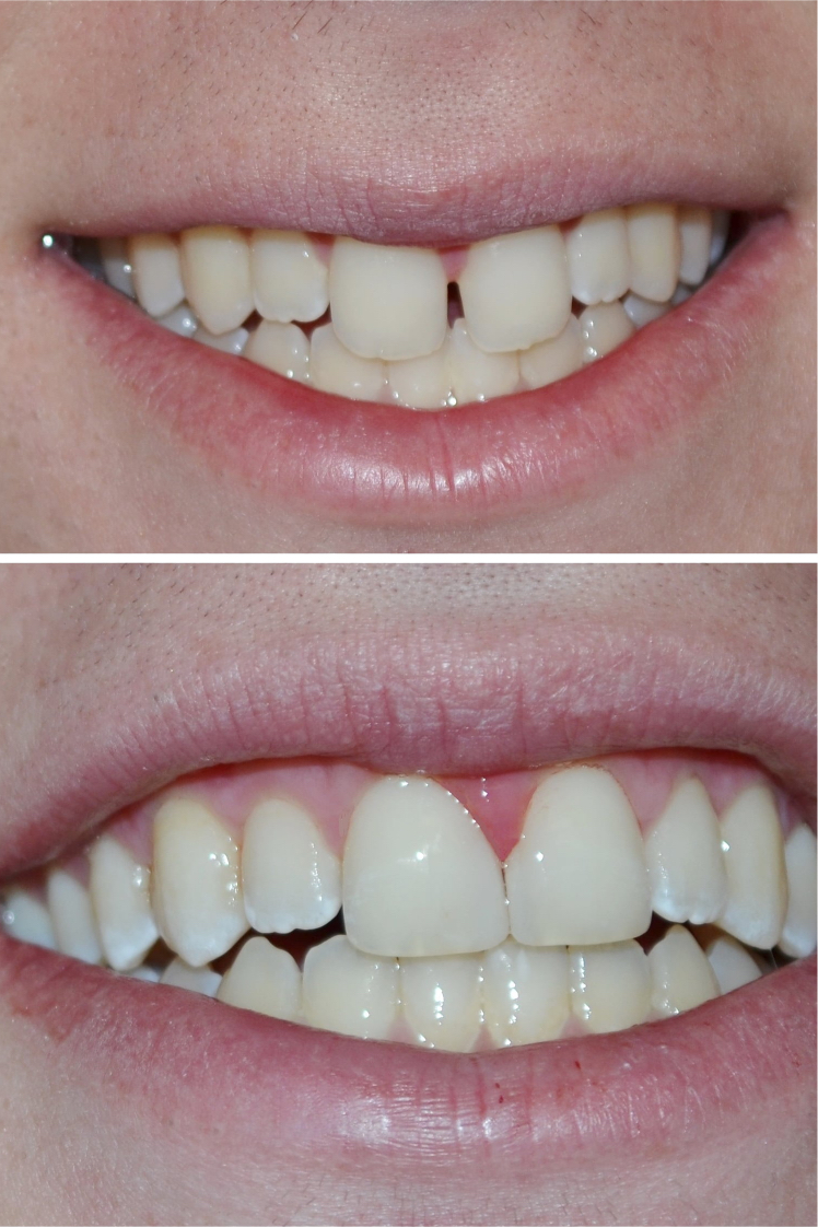 Dental Tooth-Colored Fillings After Louisville Kentucky