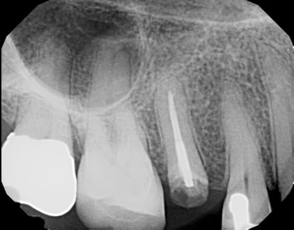 Before Dental Tooth Implant Louisville Kentucky