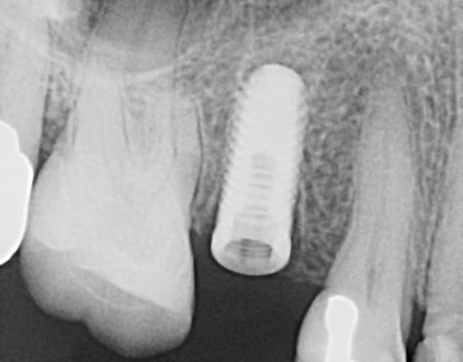 After Dental Tooth Implant Louisville Kentucky