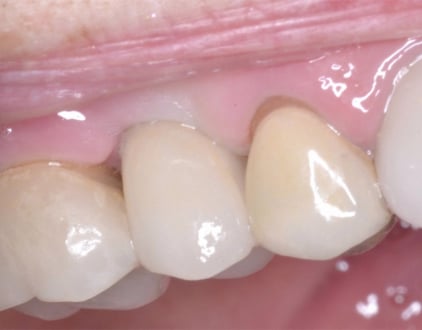 After Porcelain Crown Implant Louisville Kentucky
