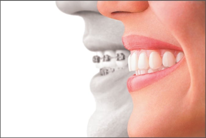 After Invisalign Braces Aligners Louisville Kentucky