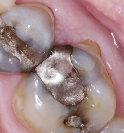 Dental Digital Photography Cavity Dentist Louisville Kentucky