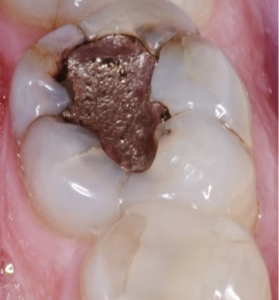 Dental Digital Photography Cavities Dentist Louisville Kentucky