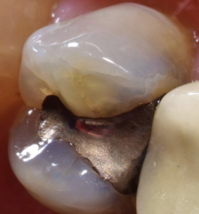 Dental Digital Photography Silver Cavity Dentist Louisville Kentucky