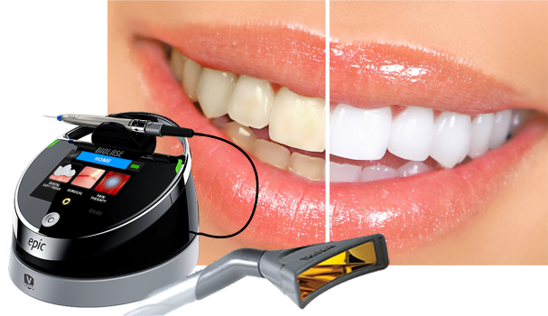 Teeth Whitening Biolase Dental Laser Louisville Kentucky