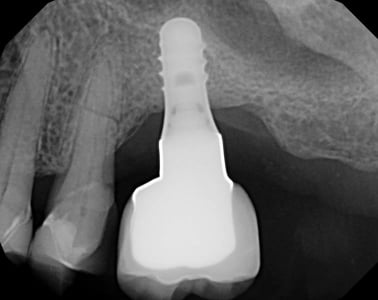 Digital X-Rays Radiographs Fractured Root Dentist Louisville Kentucky
